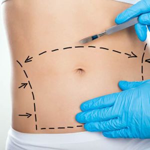 chirurgie abdominoplastie