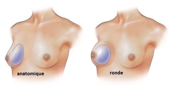 augmentation mammaire par prothese