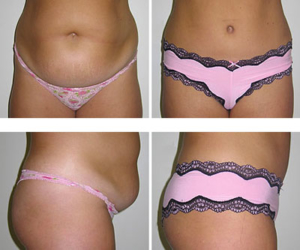 abdominoplastie tunisie avant apres