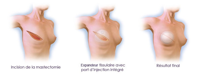 reconstruction seins tunisie