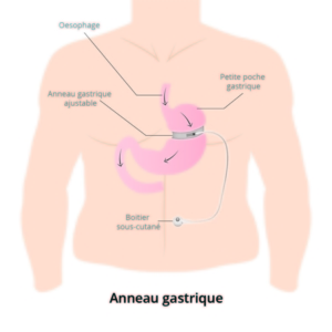 anneau gastrique prix tunisie