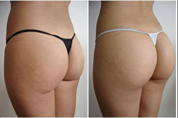 augmentation fesses tunisie avis