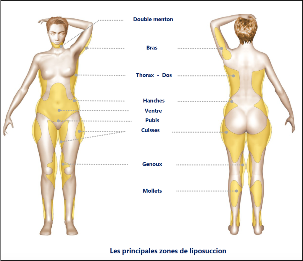 lipoaspiration tunisie