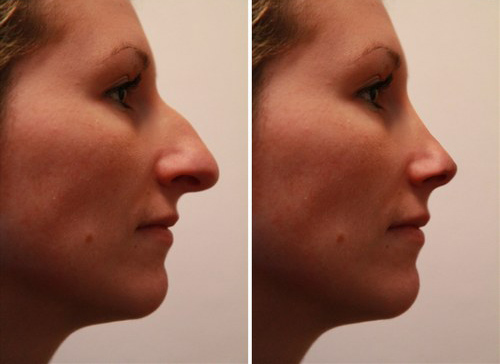 rhinoplastie tunisie avis