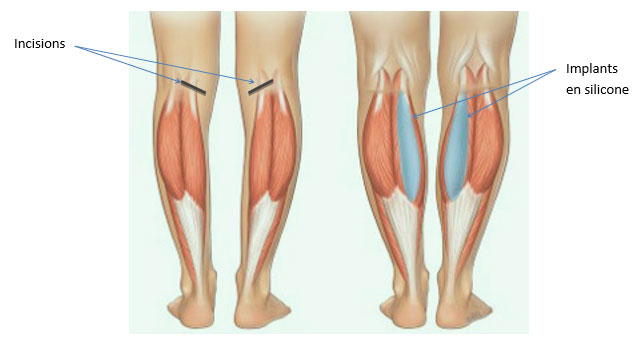 augmentation mollets par implant