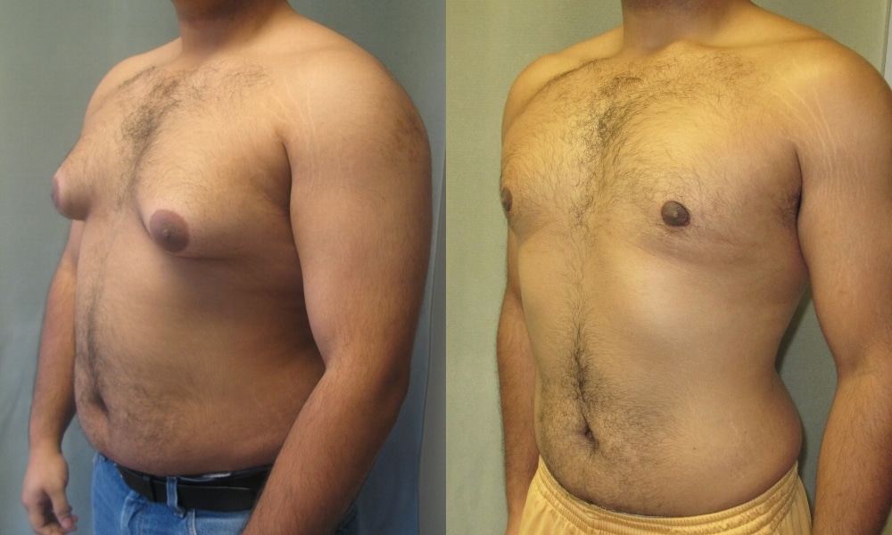 gynecomastie avant apres