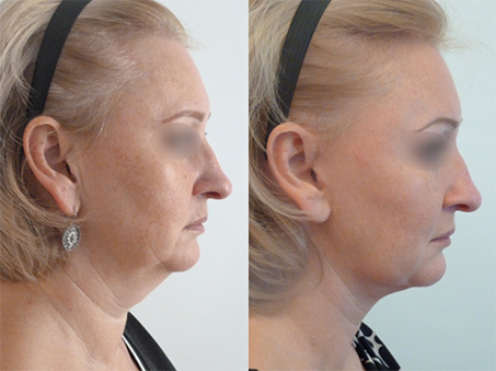 lifting cervico facial avant apres