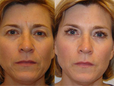 lipofilling visage avant apres