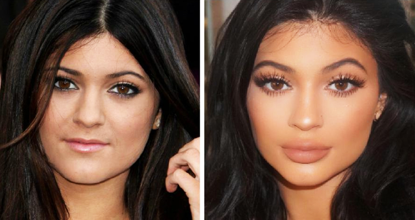 Kylie Jenner avant apres