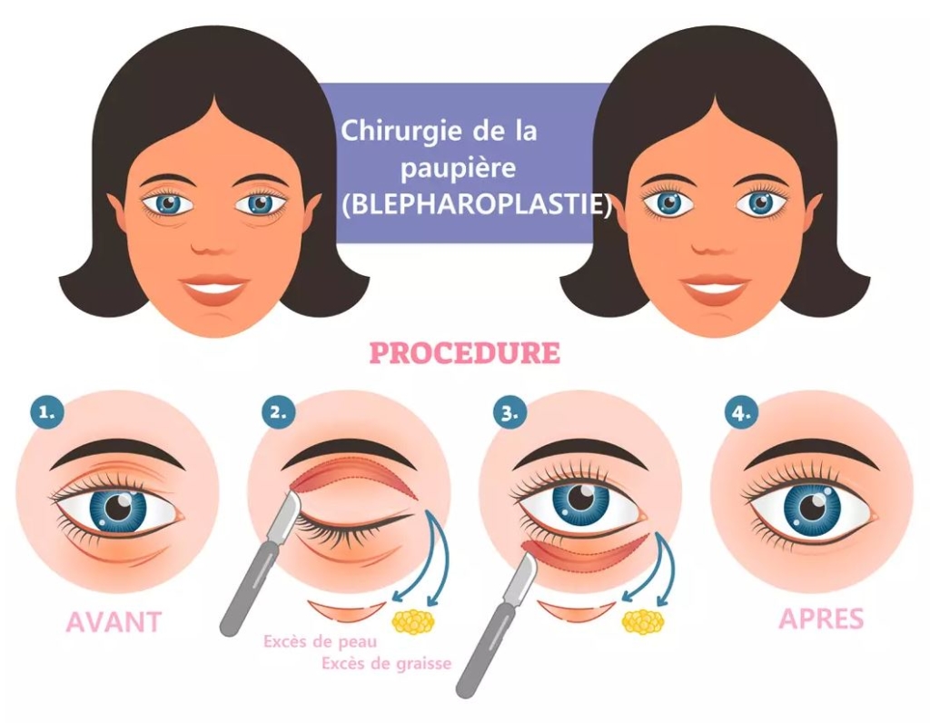 suite operatoire blepharoplastie forum