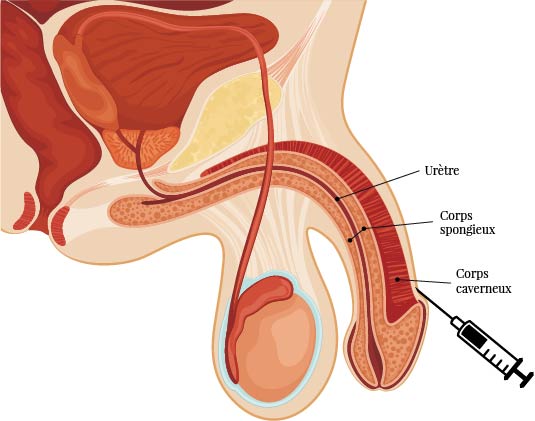 Pénoplastie médicale par injection d'acide hyaluronique